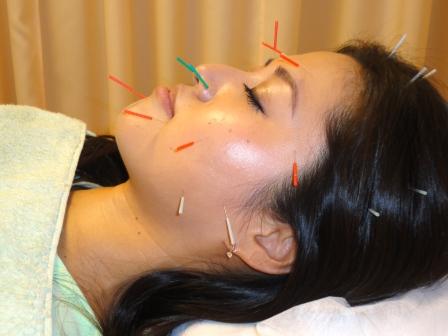 Cosmetic acupuncture.